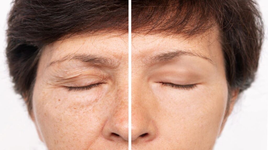 mesotherapy before and after face