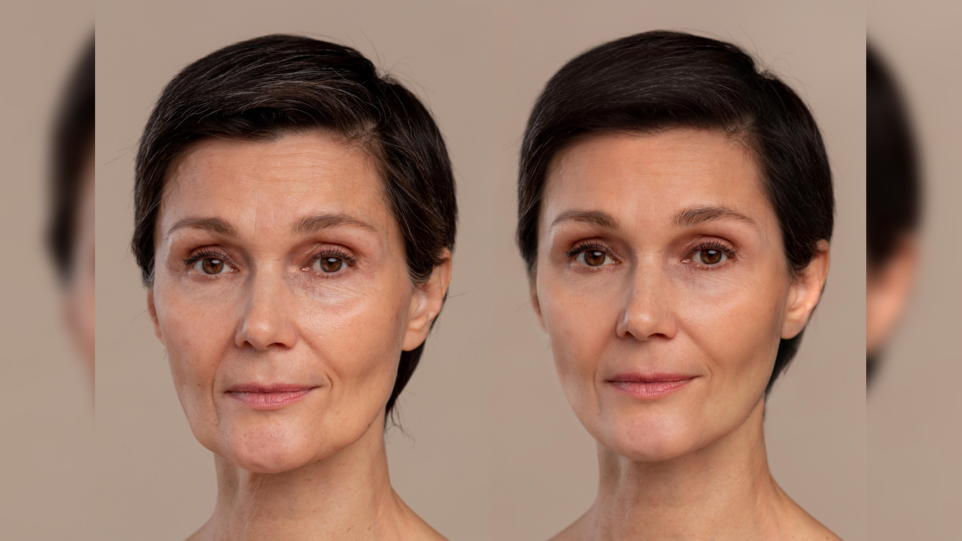 microneedling for fine lines