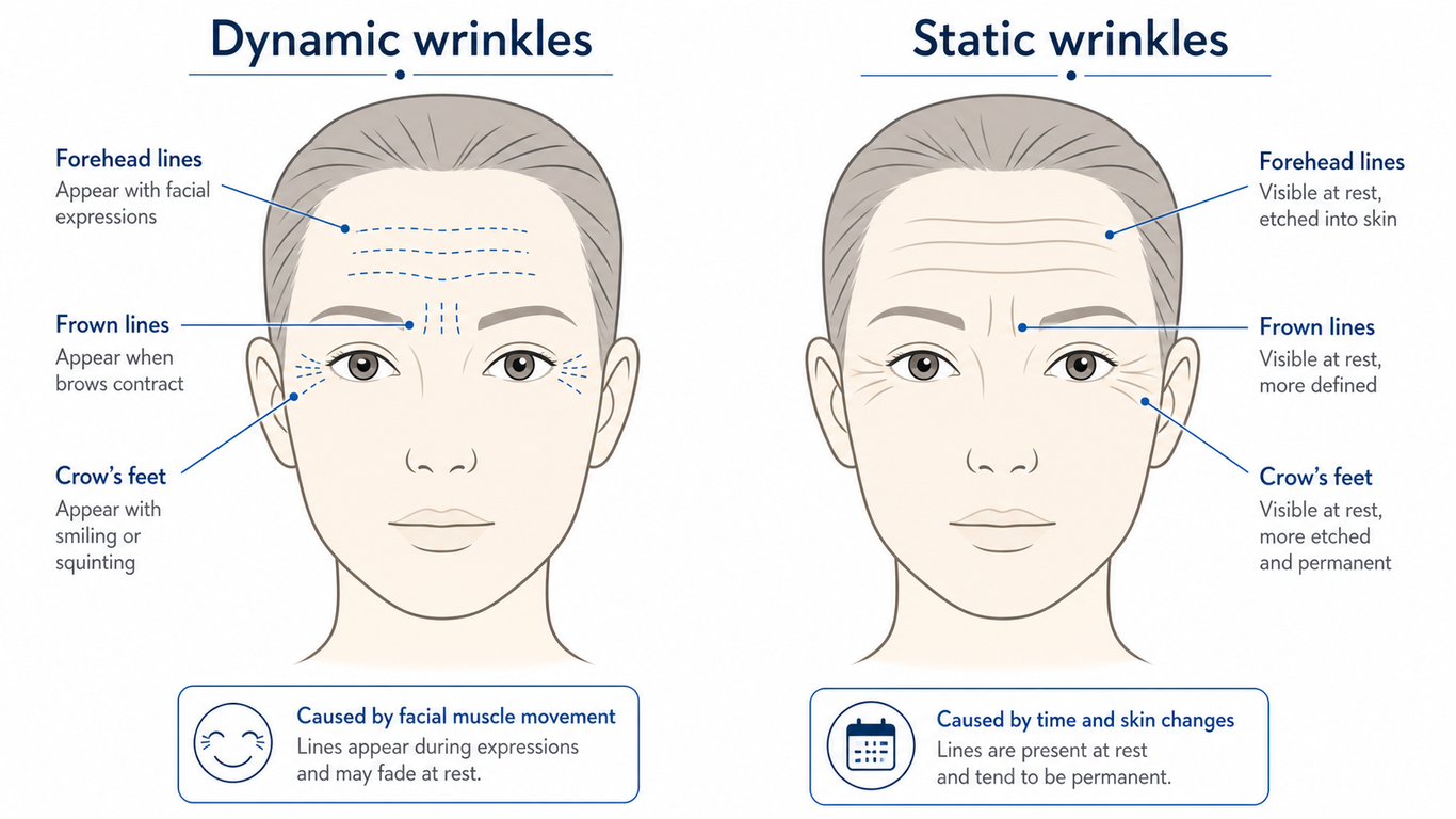 dynamic vs. static wrinkles