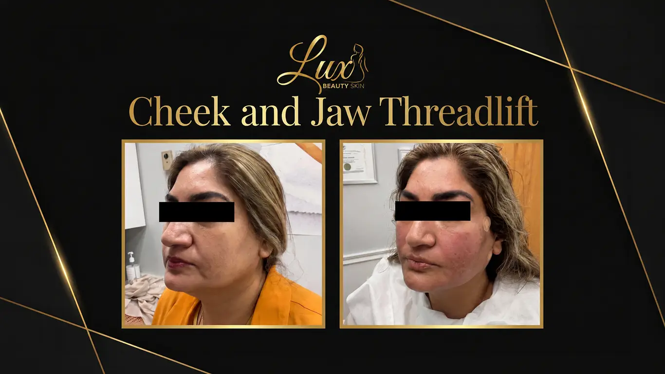 thread lift before and after