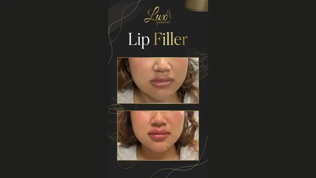 lip filler before after